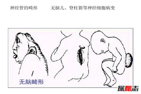史上最奇葩小孩：尼古拉斯·柯克，先天无脑奇迹存活3年585 / 作者:UFO爱好者 / 帖子ID:96153
