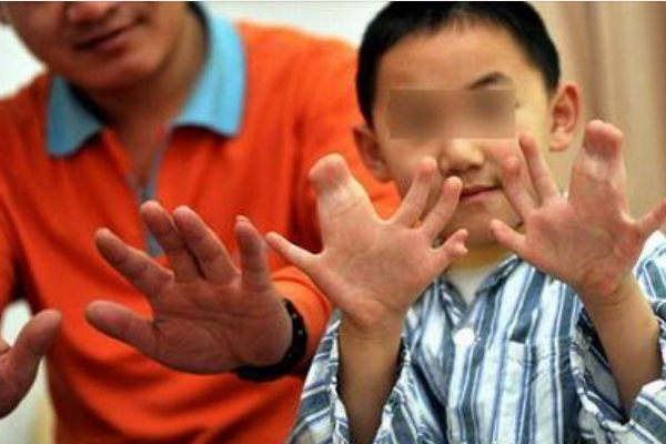 世界手指和脚趾最多的人:共34根(脚趾20根/手指14根)24 / 作者:UFO爱好者 / 帖子ID:94022