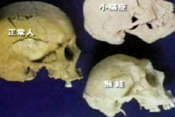 猴娃是什么病?脑容量仅671cc(不如婴儿大/确诊小脑症)130 / 作者:UFO爱好者 / 帖子ID:67246