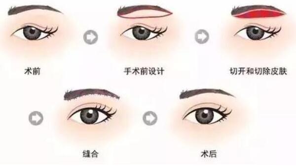 为什么切眉会老得快，本身不适合切眉（或手术方案不合理）946 / 作者:UFO爱好者 / 帖子ID:90238