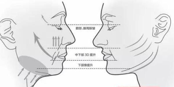 大v线提拉危害，发胀并发症/面部凹陷后遗症（去正规机构危害小）101 / 作者:UFO爱好者 / 帖子ID:90121