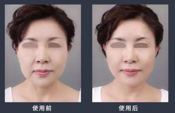 大v线提拉危害，发胀并发症/面部凹陷后遗症（去正规机构危害小）566 / 作者:UFO爱好者 / 帖子ID:90121