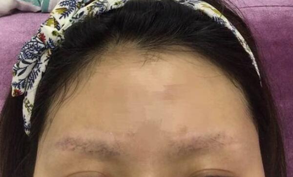 洗眉会痛吗，洗眉后多久可以沾水（手术小3天内不要沾水）647 / 作者:UFO爱好者 / 帖子ID:87649