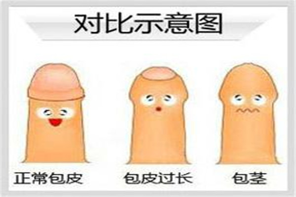 割包皮为什么很多人后悔?割包皮好处和坏处有哪些784 / 作者:UFO爱好者 / 帖子ID:100556