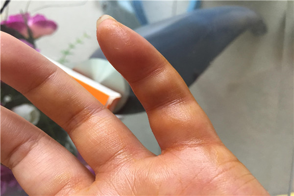 被蜜蜂蛰了怎么处理 四大处理方法帮助你处理伤口409 / 作者:UFO爱好者 / 帖子ID:102158