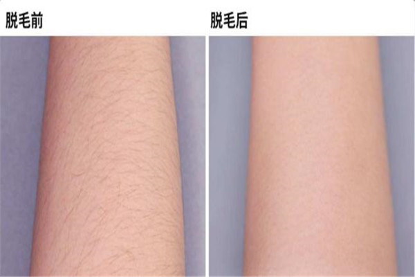 激光脱毛6年后后悔了 激光脱毛并不是永久的可能反弹276 / 作者:UFO爱好者 / 帖子ID:101615