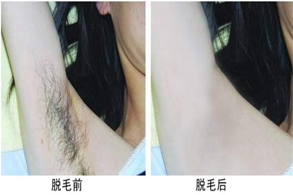 激光脱毛6年后后悔了 激光脱毛并不是永久的可能反弹478 / 作者:UFO爱好者 / 帖子ID:101615