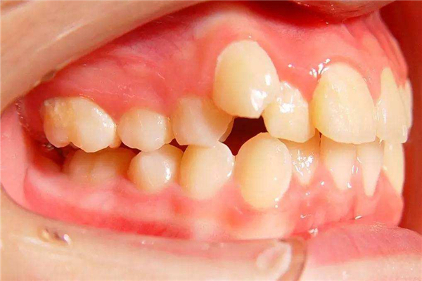 世界上门牙最大的人 来自加拿大的9岁男孩（长2.28cm）798 / 作者:UFO爱好者 / 帖子ID:90881