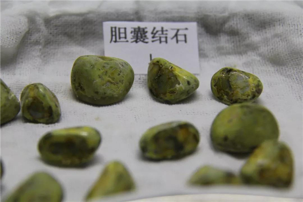 世界上最大的人体胆结石 位于英国老妇人身上（12.58kg）437 / 作者:UFO爱好者 / 帖子ID:90978