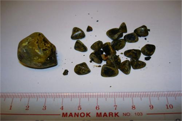 世界上最大的人体胆结石 位于英国老妇人身上（12.58kg）574 / 作者:UFO爱好者 / 帖子ID:90978