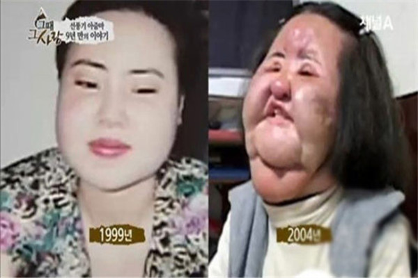 韩国电风扇大妈现状 因整容过度导致面目全非（已去世）725 / 作者:UFO爱好者 / 帖子ID:99591