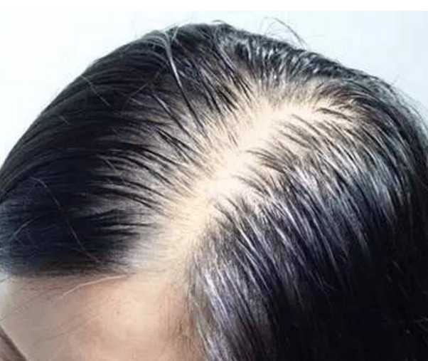 脱发是什么原因引起的，原因有很多你是哪一种101 / 作者:UFO爱好者 / 帖子ID:73734