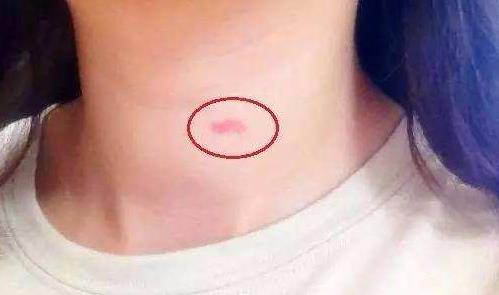 种草莓的梗是什么意思 种草莓技巧吻痕图片 草莓就是吻痕的意思935 / 作者:UFO爱好者 / 帖子ID:68842