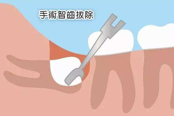 智齿不用拔的三种情况:智齿正常，智齿阻生，智齿没长出855 / 作者:UFO爱好者 / 帖子ID:78307