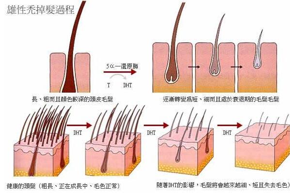 脱发是什么原因引起的?与遗传因素有关，预兆身体有疾病61 / 作者:UFO爱好者 / 帖子ID:77159