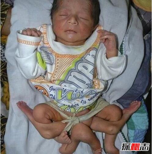 巴基斯坦6条腿的男婴，堂兄妹通婚生6条腿男孩/寄生胎儿257 / 作者:UFO爱好者 / 帖子ID:106378
