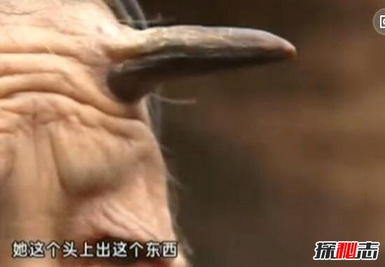 百岁老人头上长“犄角”之谜，预示癌症病变(皮肤肿瘤)274 / 作者:UFO爱好者 / 帖子ID:98818
