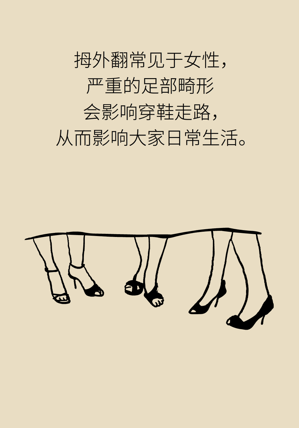 拇指外翻要做手术吗？这6种方法值得学习90 / 作者:UFO爱好者 / 帖子ID:72027
