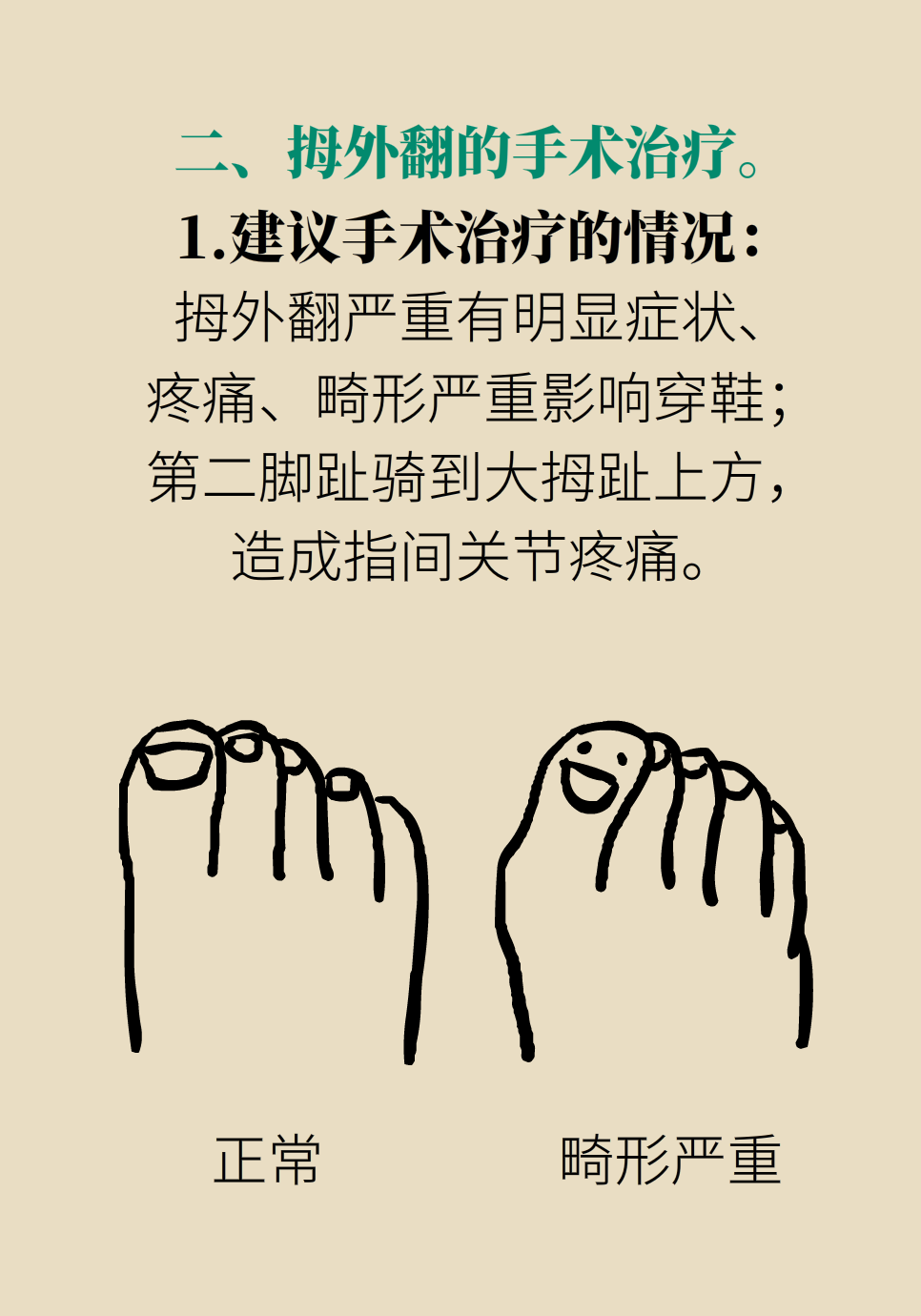 拇指外翻要做手术吗？这6种方法值得学习421 / 作者:UFO爱好者 / 帖子ID:72027