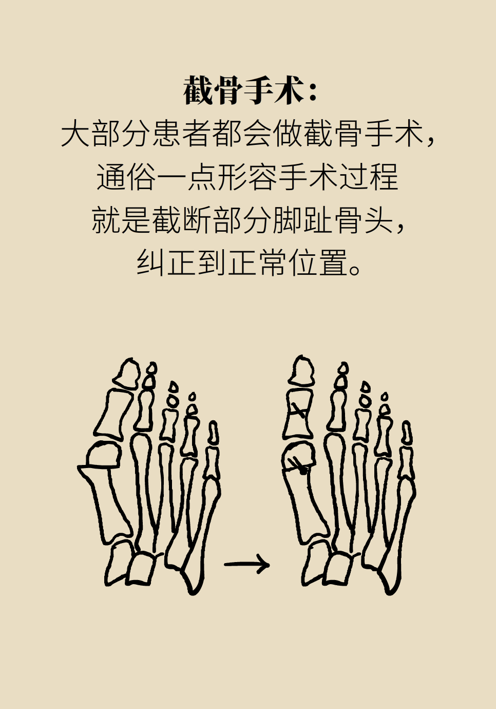 拇指外翻要做手术吗？这6种方法值得学习922 / 作者:UFO爱好者 / 帖子ID:72027