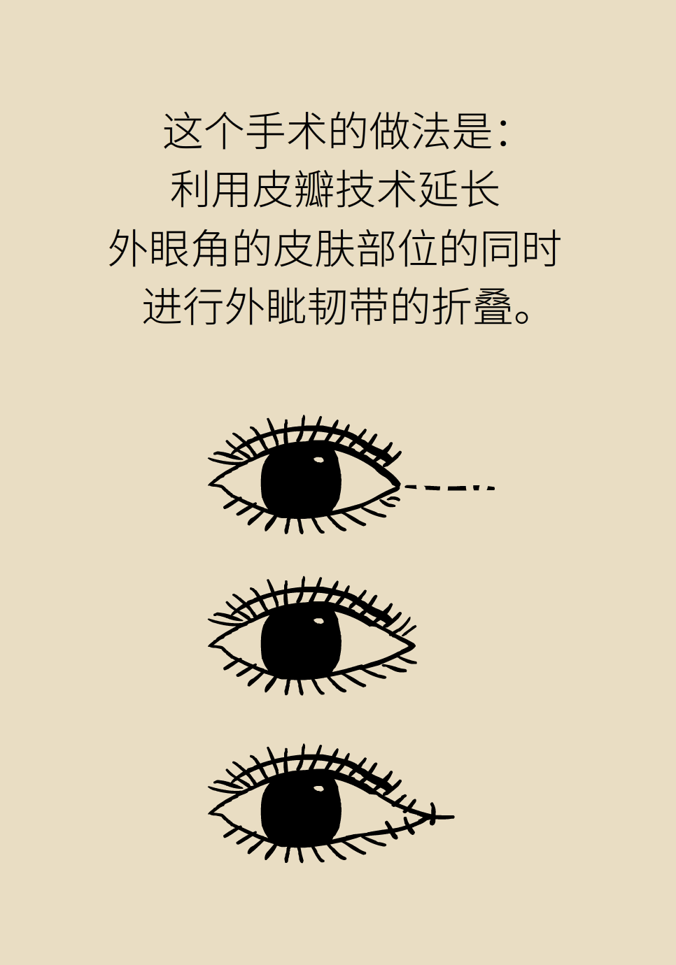 开眼角真的能让眼睛变大吗？关键要注意这一点242 / 作者:UFO爱好者 / 帖子ID:71529
