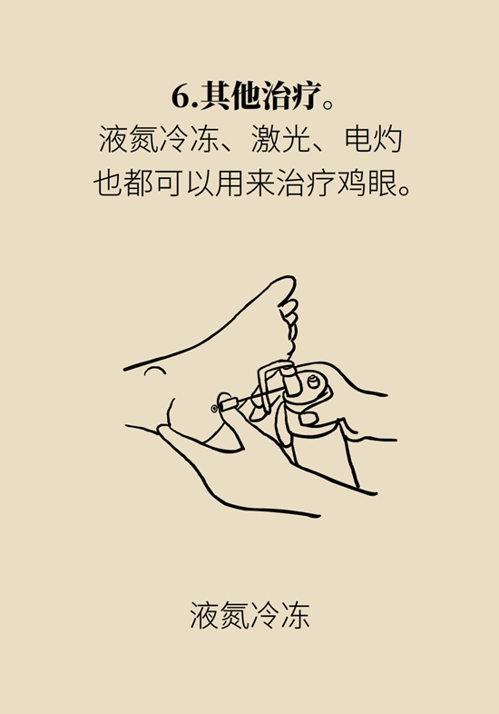 长了鸡眼和老茧怎么办？这份防治指南请收好676 / 作者:UFO爱好者 / 帖子ID:71145