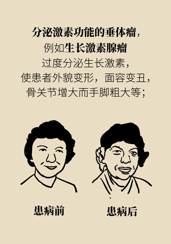 变丑、变胖、内分泌失调……这些糟心事警惕脑肿瘤526 / 作者:UFO爱好者 / 帖子ID:70967