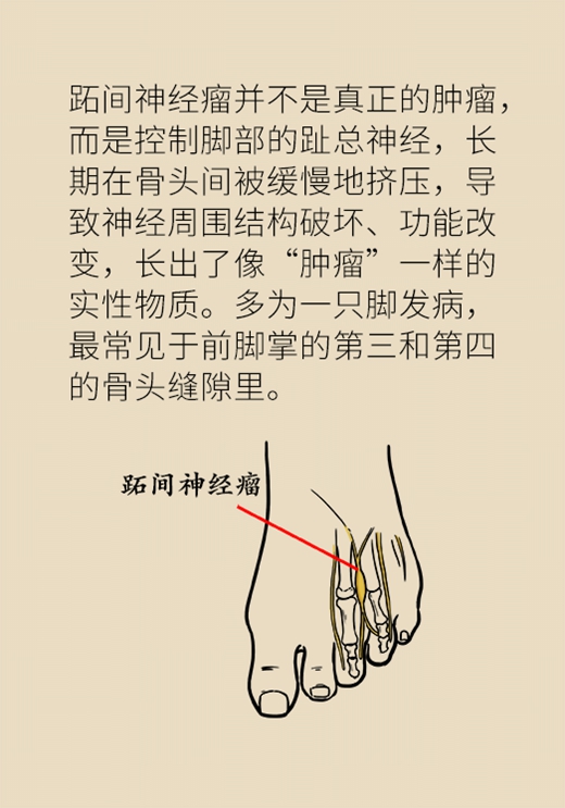 穿高跟鞋竟然穿出脚“肿瘤”，这些症状你有没有？555 / 作者:UFO爱好者 / 帖子ID:70961