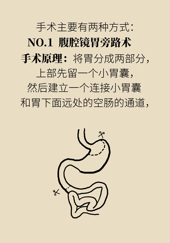 哪些人能做减重手术？医生：符合这个指标才行699 / 作者:UFO爱好者 / 帖子ID:70755
