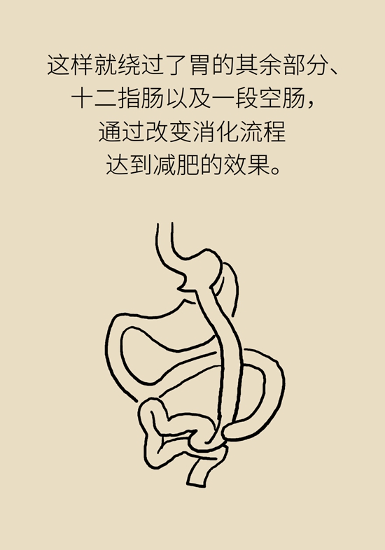 哪些人能做减重手术？医生：符合这个指标才行460 / 作者:UFO爱好者 / 帖子ID:70755