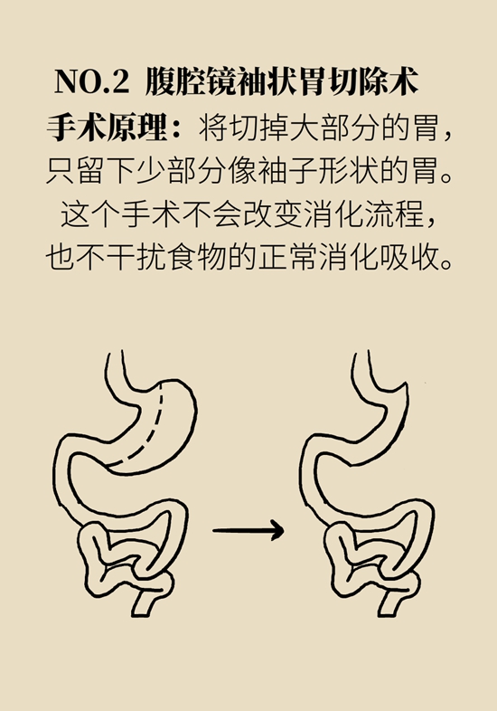 哪些人能做减重手术？医生：符合这个指标才行89 / 作者:UFO爱好者 / 帖子ID:70755