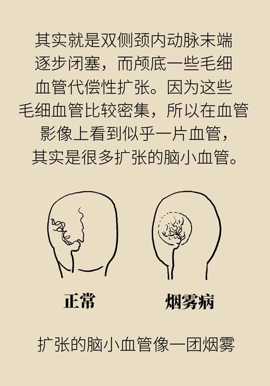 烟雾病是什么病？和脑卒中有关？解密大脑中的“烟雾”316 / 作者:UFO爱好者 / 帖子ID:70574