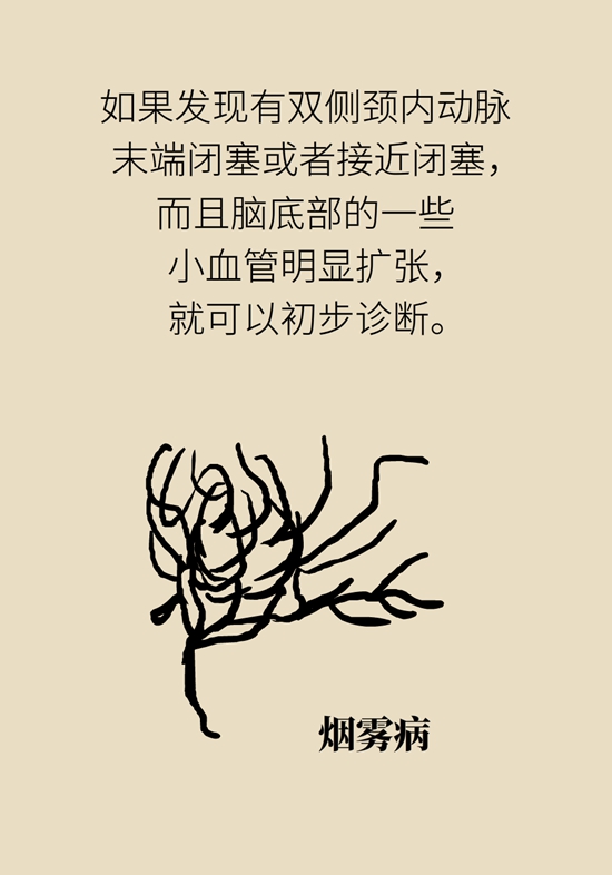 烟雾病是什么病？和脑卒中有关？解密大脑中的“烟雾”193 / 作者:UFO爱好者 / 帖子ID:70574