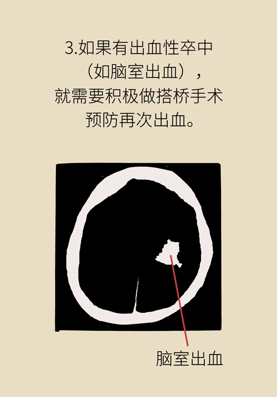 烟雾病是什么病？和脑卒中有关？解密大脑中的“烟雾”459 / 作者:UFO爱好者 / 帖子ID:70574