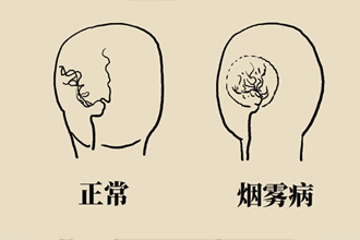 烟雾病是什么病？和脑卒中有关？解密大脑中的“烟雾”256 / 作者:UFO爱好者 / 帖子ID:70574
