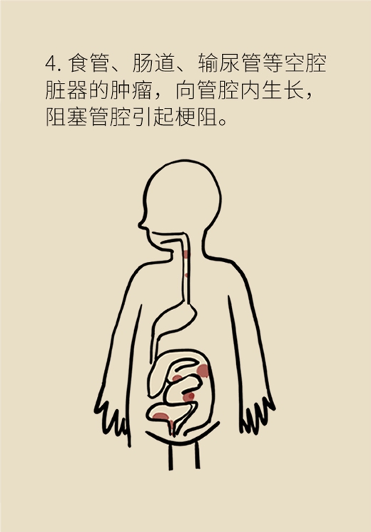 怎样的疼痛会是癌症？有了这种痛千万别忍着174 / 作者:UFO爱好者 / 帖子ID:70337
