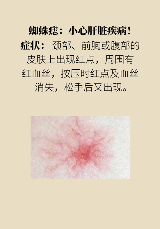 身上出现红斑、红点别不当回事，警惕癌变338 / 作者:UFO爱好者 / 帖子ID:70329