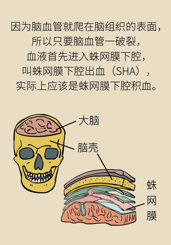 蛛网膜下腔出血是脑卒中吗？5大病因要提前了解484 / 作者:UFO爱好者 / 帖子ID:70317