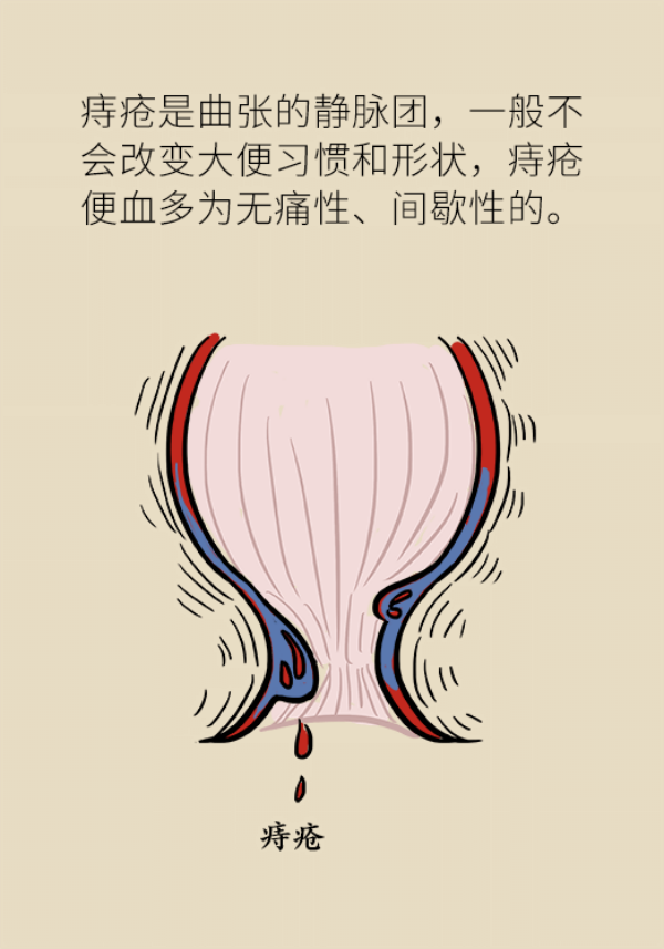便血查出直肠癌？三招教你辨别是痔疮还是癌392 / 作者:UFO爱好者 / 帖子ID:70127