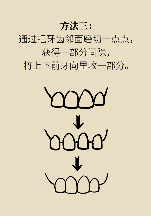 “龅牙”矫正不可盲目，四类嘴突类型要对症下药！312 / 作者:UFO爱好者 / 帖子ID:70120