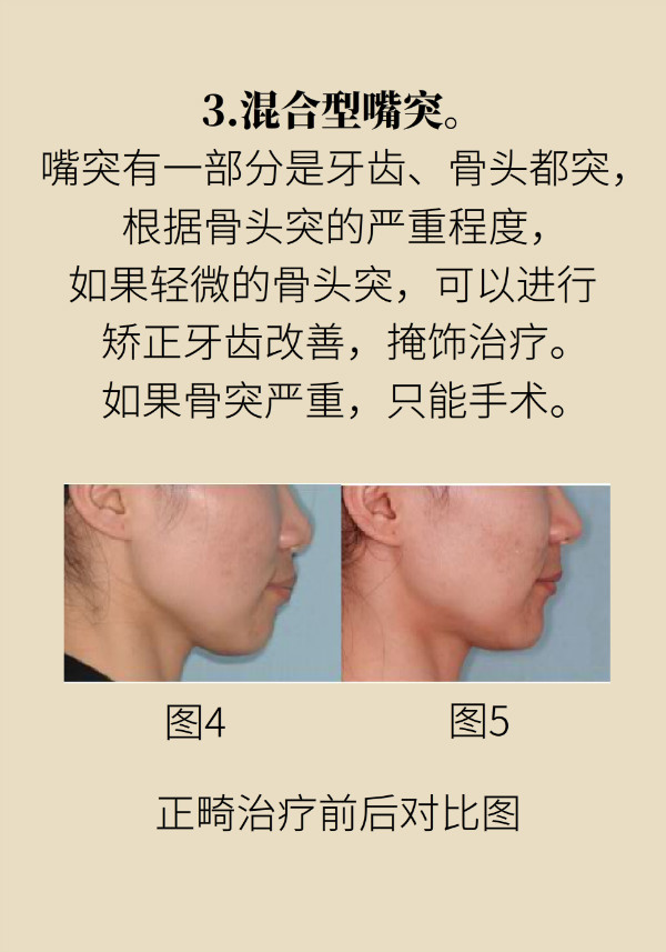 “龅牙”矫正不可盲目，四类嘴突类型要对症下药！577 / 作者:UFO爱好者 / 帖子ID:70120