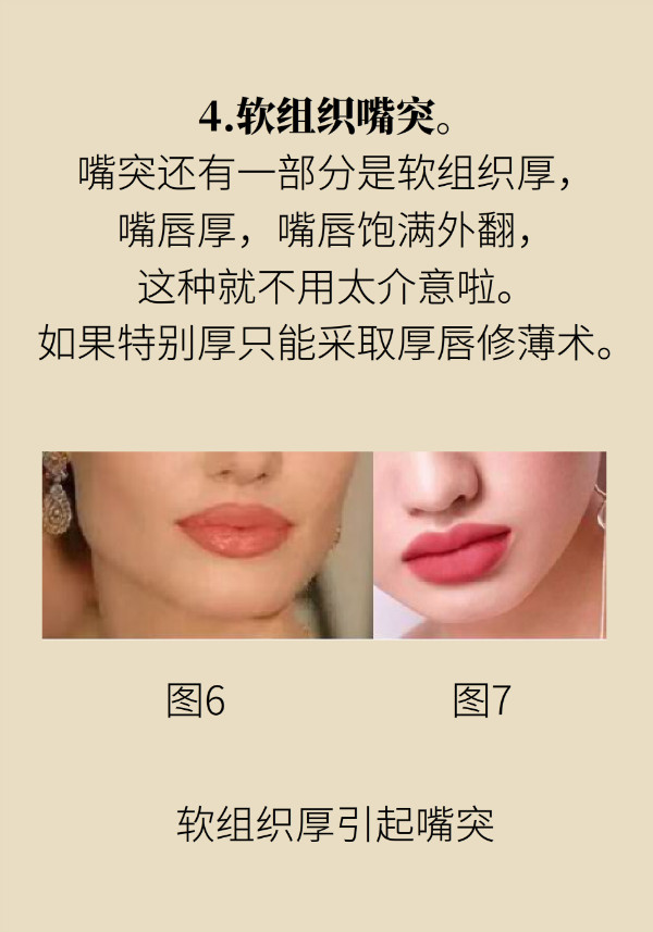 “龅牙”矫正不可盲目，四类嘴突类型要对症下药！154 / 作者:UFO爱好者 / 帖子ID:70120