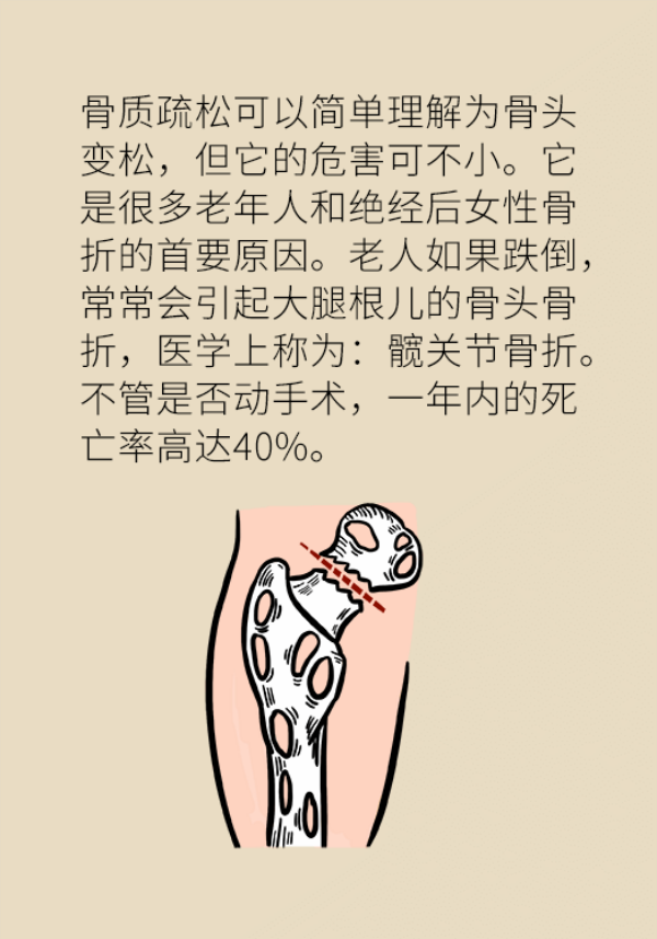 骨质疏松危害大！专家教你如何科学补钙161 / 作者:UFO爱好者 / 帖子ID:70110