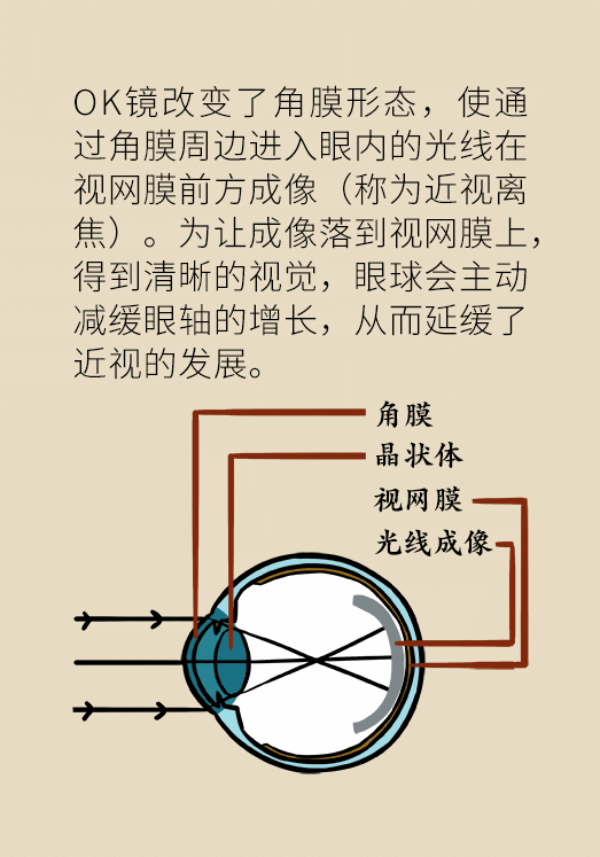 孩子近视度数嗖嗖地涨，戴OK镜真能缓解近视吗？227 / 作者:UFO爱好者 / 帖子ID:70096