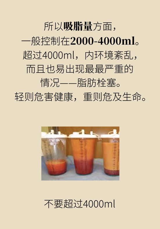 吸脂手术咋吸的？吸得越多越好？遵循四原则665 / 作者:UFO爱好者 / 帖子ID:69201