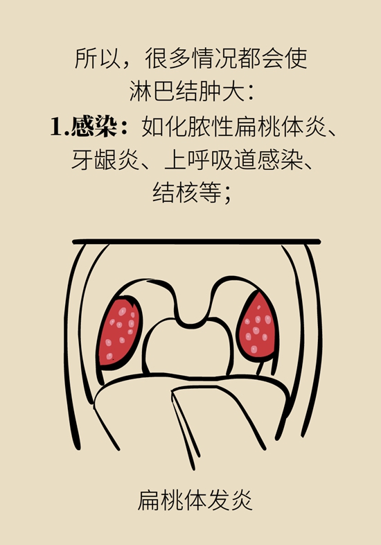 淋巴结肿大预示着哪些疾病？这样“摸”可自查874 / 作者:UFO爱好者 / 帖子ID:69211