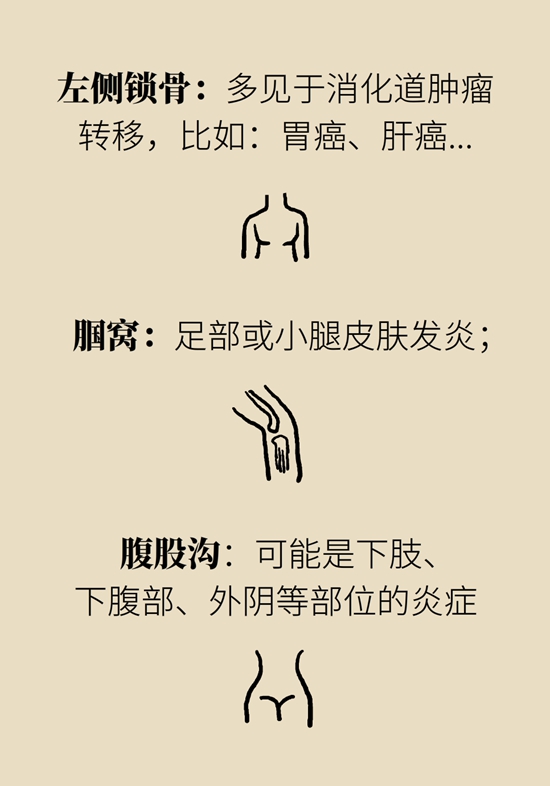 淋巴结肿大预示着哪些疾病？这样“摸”可自查77 / 作者:UFO爱好者 / 帖子ID:69211