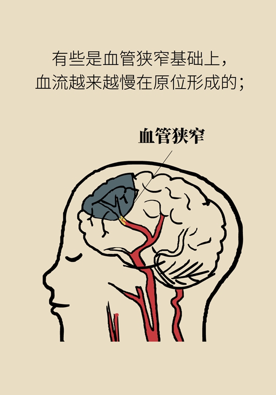 脑血管堵塞还能通吗？了解一下再灌注治疗912 / 作者:UFO爱好者 / 帖子ID:68972