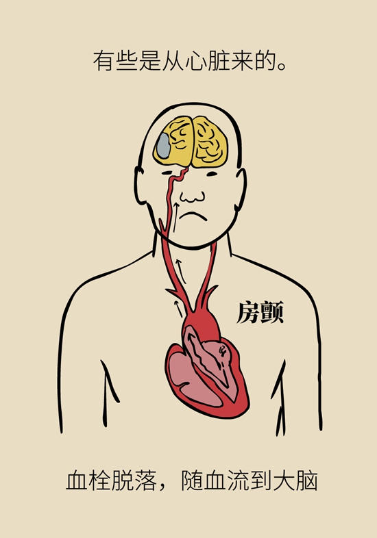 脑血管堵塞还能通吗？了解一下再灌注治疗602 / 作者:UFO爱好者 / 帖子ID:68972