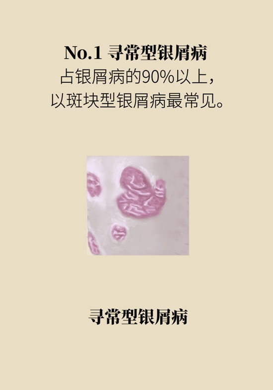 甩不掉的牛皮癣如何防治？3个误区要纠正6 / 作者:UFO爱好者 / 帖子ID:68752